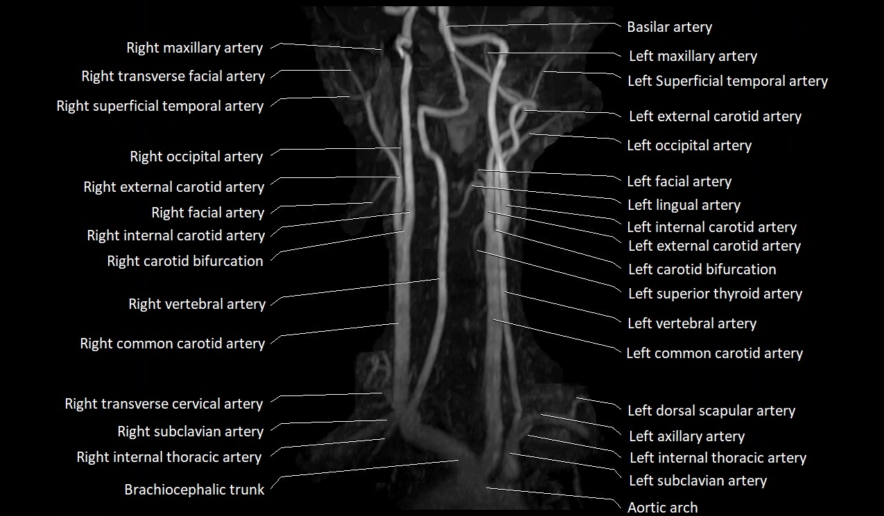 MRA neck carotid arteries labeled anatomy image MIP 3D image 3.webp